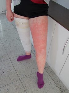 Integrativum Neurodermitis